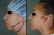 Chin/Neck Liposuction