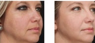 40-year-old woman has marked improvement of Rosacea and Blood Vessels on the face after a series of IPL treatments.