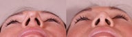 Rhinoplasty