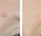 Mole Removal Before & After