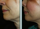 UpLift - a local anesthesia facelift