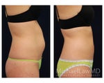 Liposuction