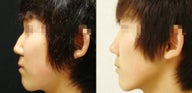 Rhinoplasty w/ Osteotomy + Tipplasty