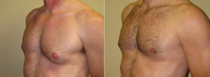 Male Breast Reduction
