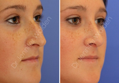 Septorhinoplasty