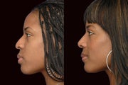 African American Rhinoplasty