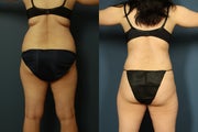 Liposuction of Abdomen and Flanks