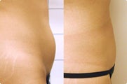 Smart Lipo: Abdomen