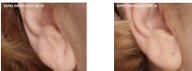 Restylane can accomplish ear lobe rejuvenation.