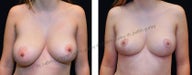 Breast Lift