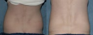 Zeltiq for fat reduction on "muffin top" / flanks