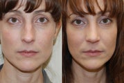 Rhinoplasty Surgery. 1 month post-op