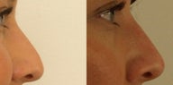 Rhinoplasty without surgery