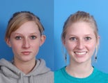 Otoplasty