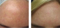 Chemical Peel