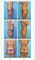 Brazilian Butt Lift Before & After