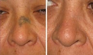 Mole Removal photos