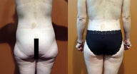 Body Lift