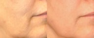 Skin rejuvenation with Sublative and ePrime combination treatment