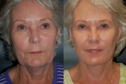 Facelift