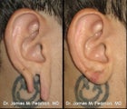Gauged and Torn Earlobe Repair