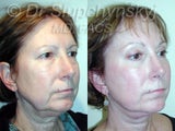 SLUPlift (Mini-lift procedure), Upper and Lower Blepharoplasty and an Endoscopic Forehead Lift