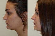 Rhinoplasty Surgery. 2 months post-op.