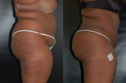 Brazilian Butt Lift