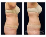 Liposuction