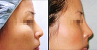 Rhinoplasty