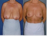 breast reduction mastopexy