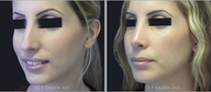 Nose Surgery