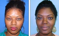 Nose Job- Rhinoplasty