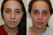 Rhinoplasty Surgery. 6 weeks post-op
