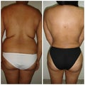 back and waist liposuction