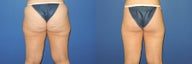 Before and after body lift, rear view