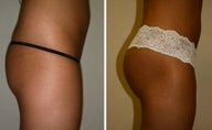 The ever so popular procedure "Brazilian Butt Lift"