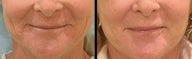 Endoscopic Mid Facelift