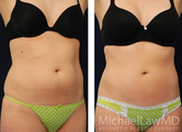 Liposuction