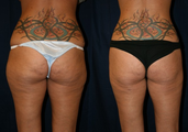 SmartLipo