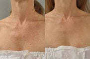 IPL (Intense Pulsed Light)