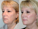 Mini Face Lift New York Combined with Eyelid Lifts