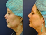 56 Year Old Female Before/After Ultherapy Full Face
