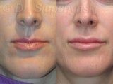 JUVEDERM® Patient