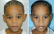 Otoplasty Plastic Surgery