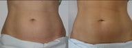 CoolSculpting