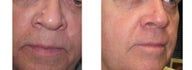 Mole Removal photos
