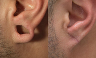 Ear Gauge repair