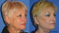 Brow Lift