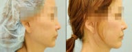 Chin Augmentation (Chin Implant)